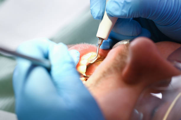 Best Knocked-Out Tooth (Avulsed Tooth) Treatment in Zumbrota, MN